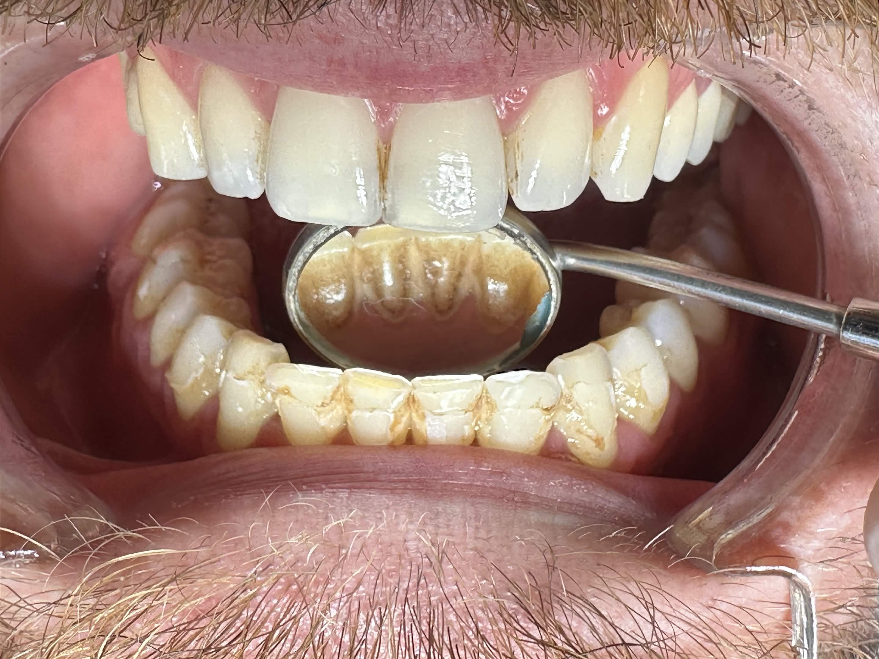 Para trajtimit dentar