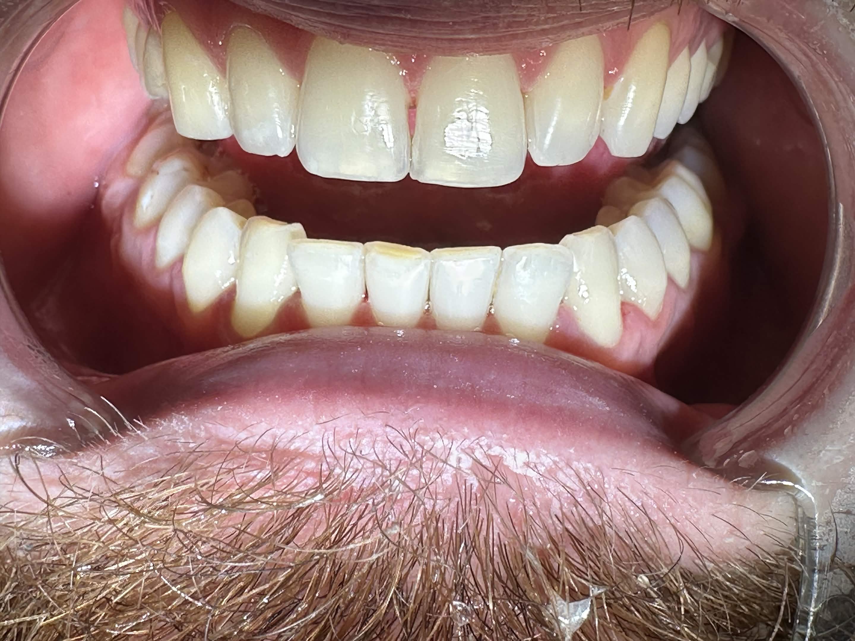 Pas trajtimit dentar